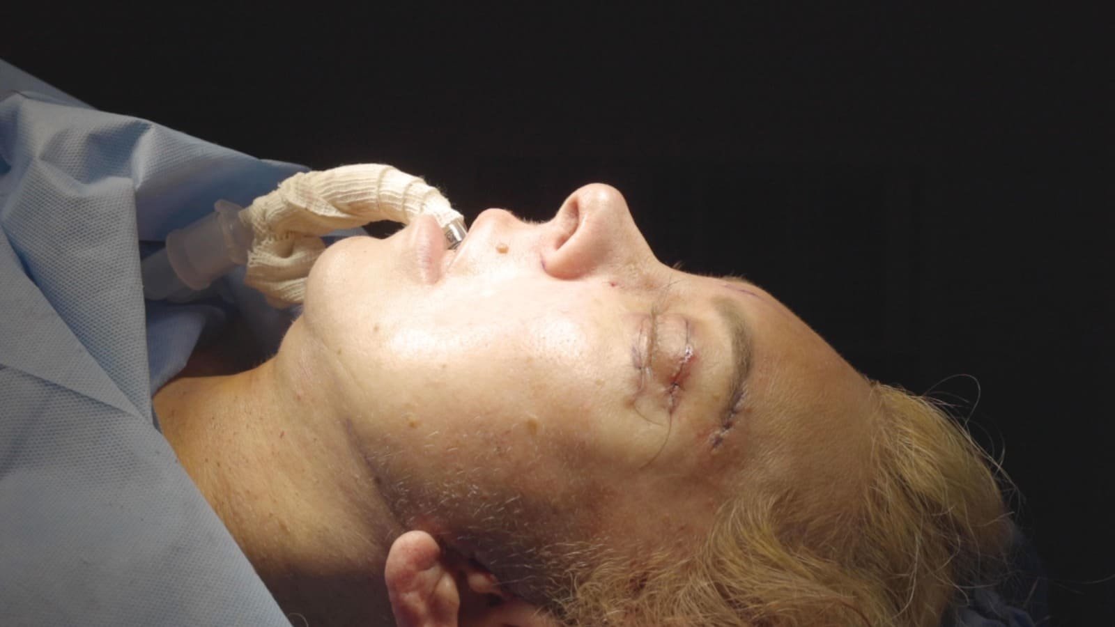 Facelift Cancún Mexico. Dr Patricia Panamá. Plastic Surgeon in Cancún Mexico. Cirujano plastico en Cancún México (22)