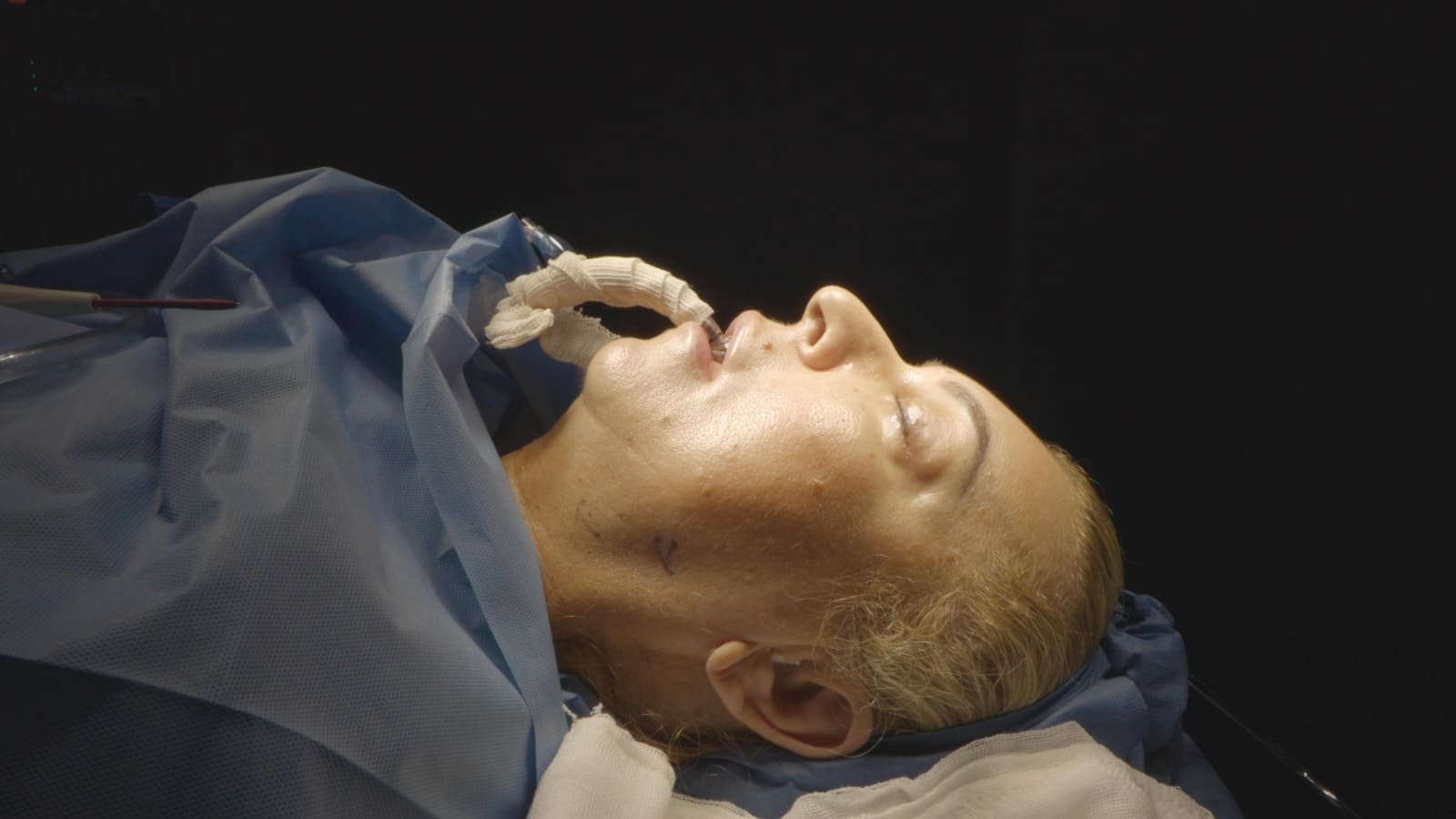 Facelift Cancún Mexico. Dr Patricia Panamá. Plastic Surgeon in Cancún Mexico. Cirujano plastico en Cancún México (23)