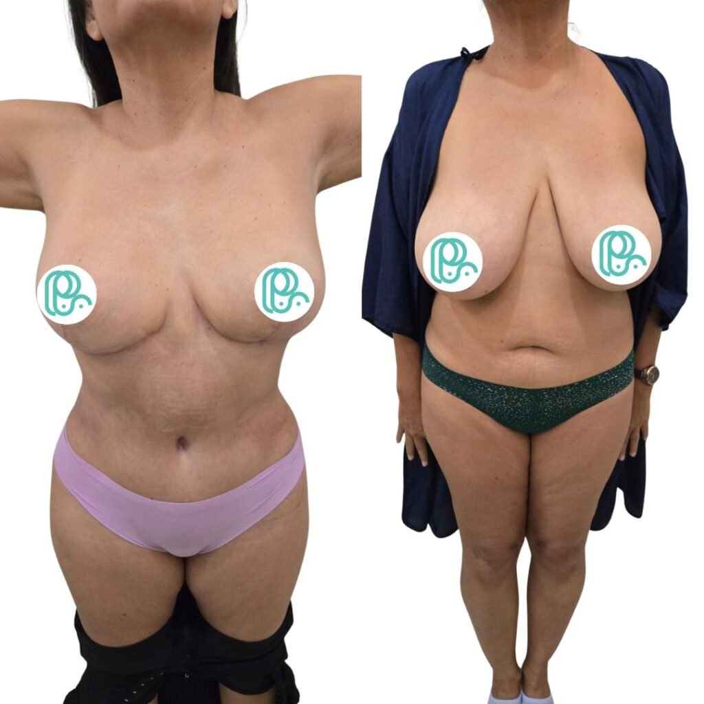 Mommy Makakeover Cancún. Dr Patricia Panamá. Cirujano Plastico en Cancún. Plastic Surgery Cancún