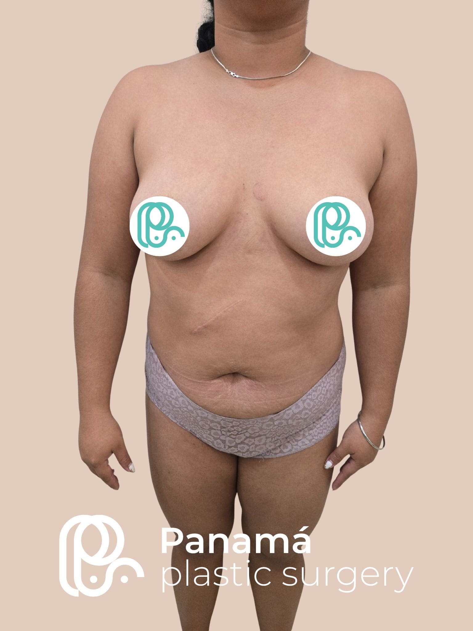 Mommy Makakeover Cancún. Dr Patricia Panamá. Cirujano Plastico en Cancún. Plastic Surgery Cancún (1)