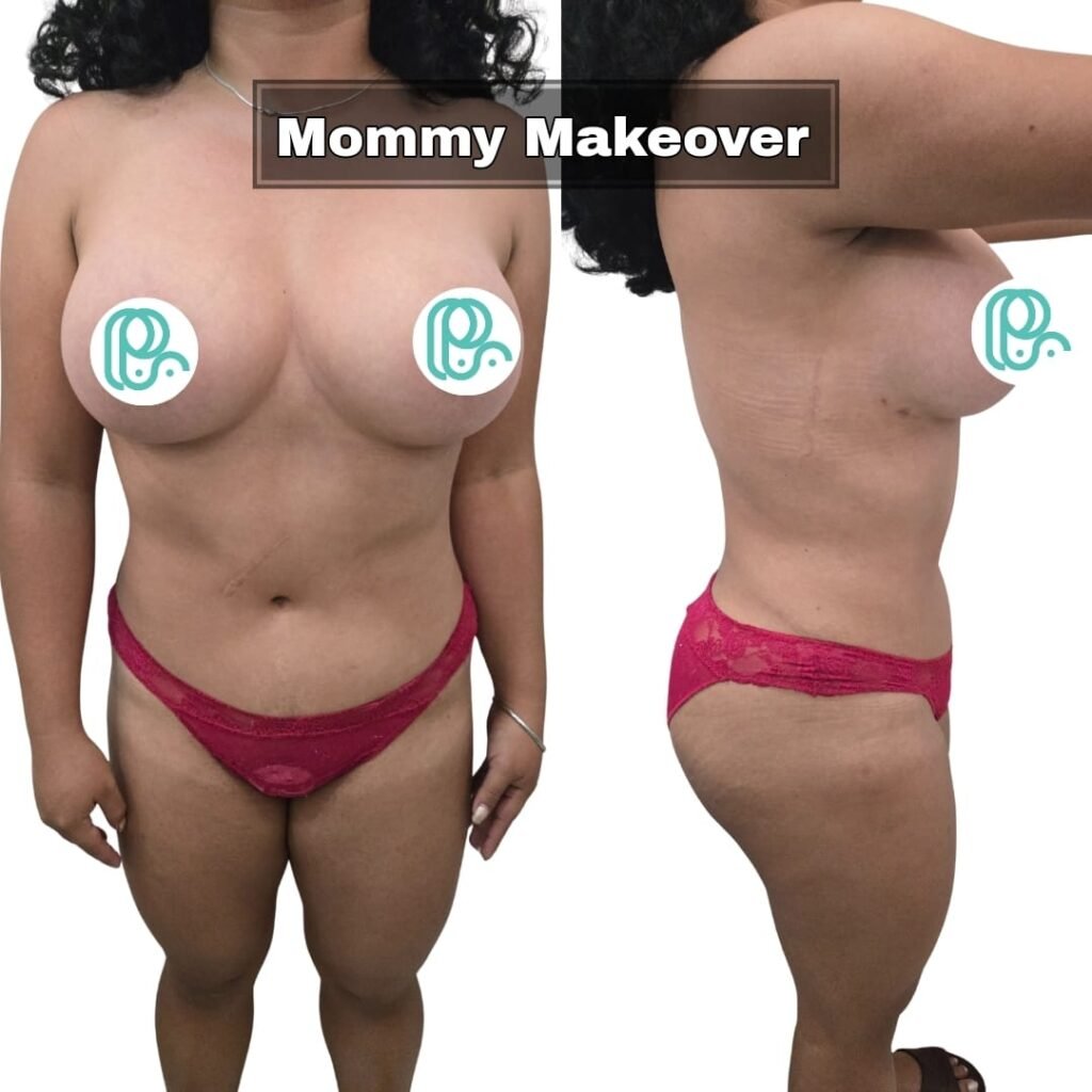 Mommy Makakeover Cancún. Dr Patricia Panamá. Cirujano Plastico en Cancún. Plastic Surgery Cancún