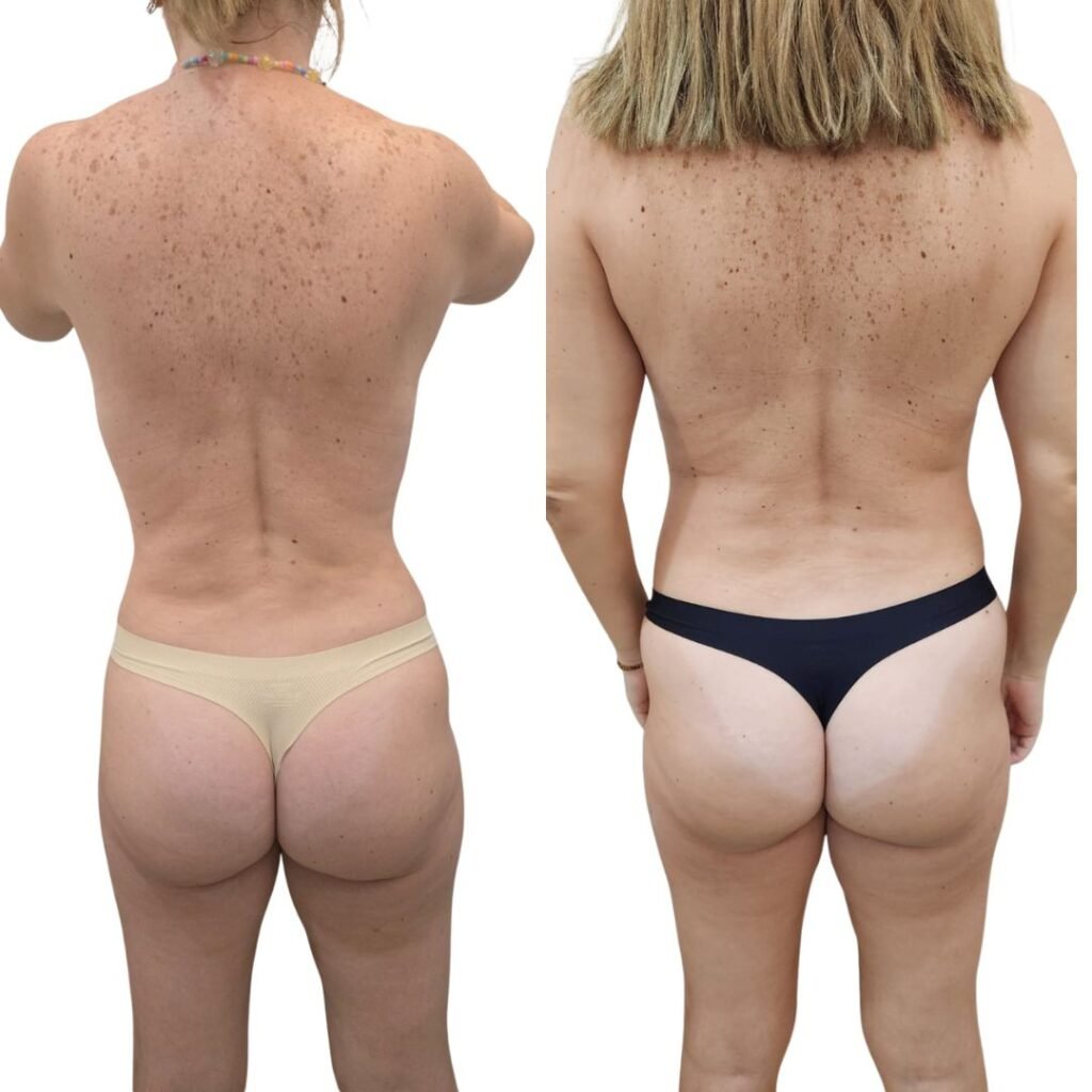 Mommy Makakeover Cancún. Dr Patricia Panamá. Cirujano Plastico en Cancún. Plastic Surgery Cancún