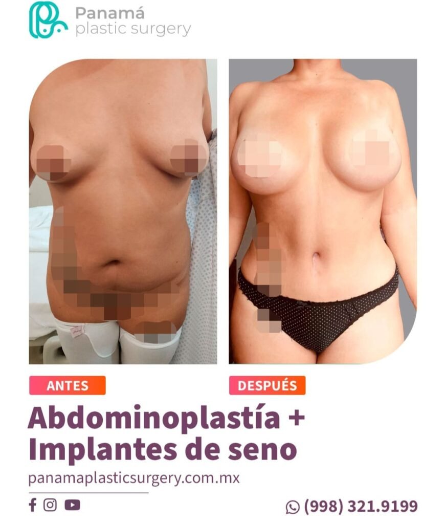 Mommy Makakeover Cancún. Dr Patricia Panamá. Cirujano Plastico en Cancún. Plastic Surgery Cancún (2)