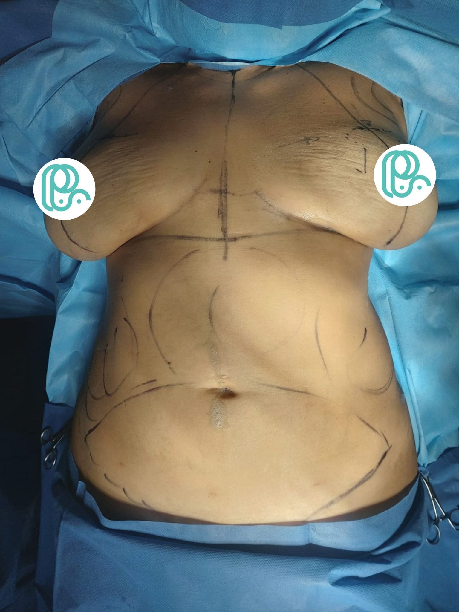 Mommy Makakeover Cancún. Dr Patricia Panamá. Cirujano Plastico en Cancún. Plastic Surgery Cancún (2)