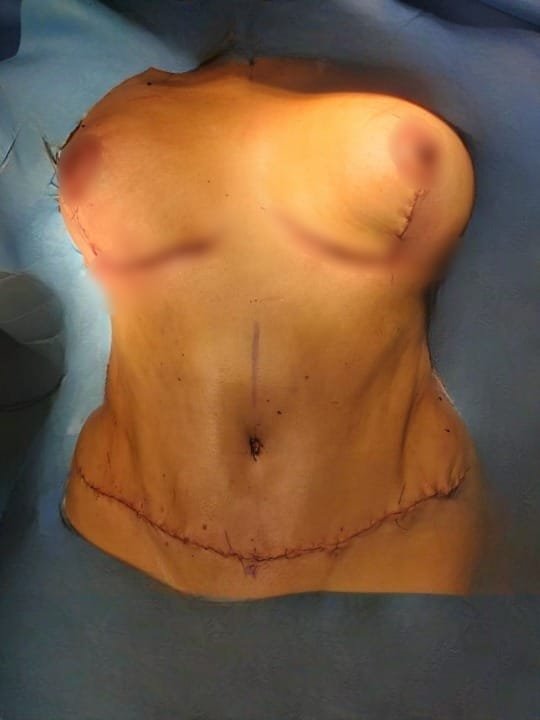 Mommy Makakeover Cancún. Dr Patricia Panamá. Cirujano Plastico en Cancún. Plastic Surgery Cancún (3)