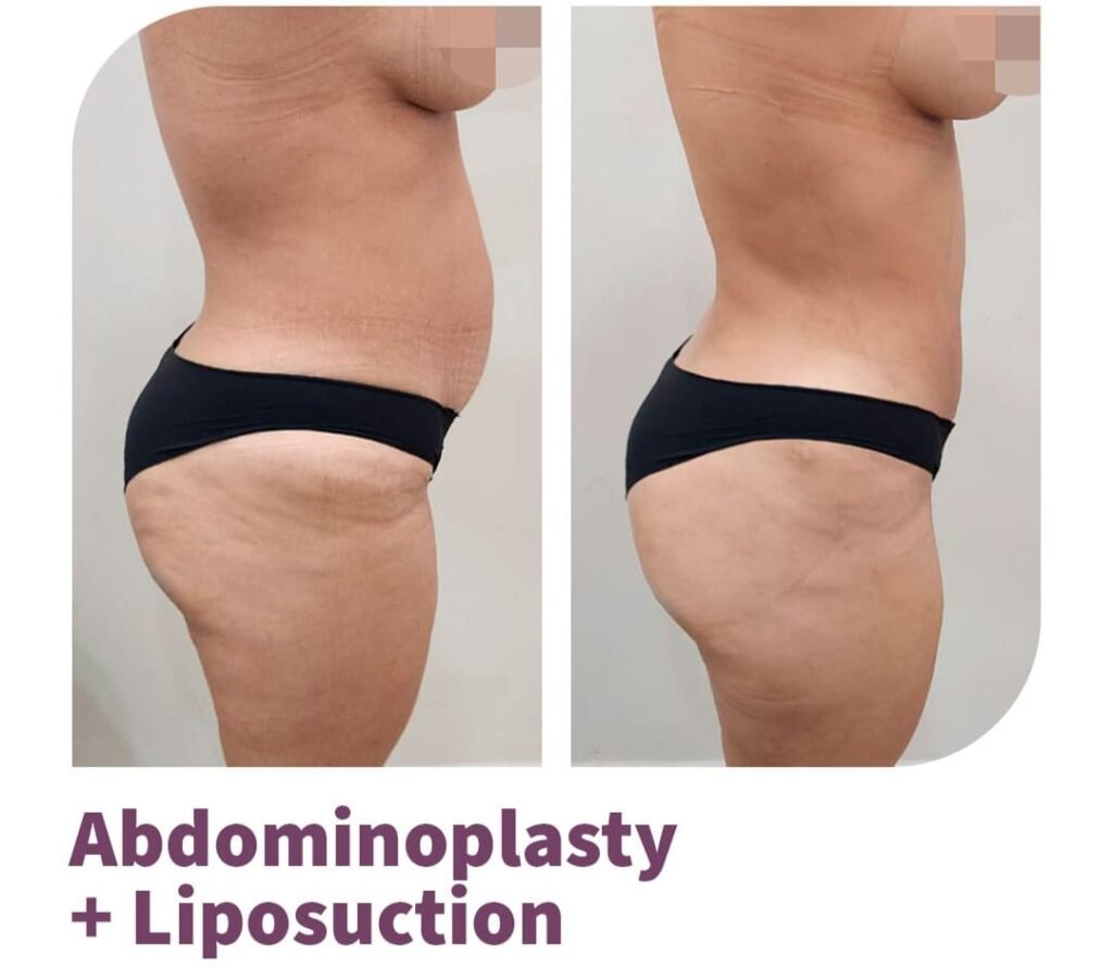 Mommy Makakeover Cancún. Dr Patricia Panamá. Cirujano Plastico en Cancún. Plastic Surgery Cancún (4}) (1)