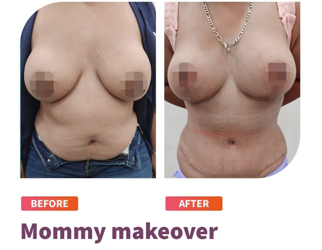 Mommy Makakeover Cancún. Dr Patricia Panamá. Cirujano Plastico en Cancún. Plastic Surgery Cancún (4}) (6)
