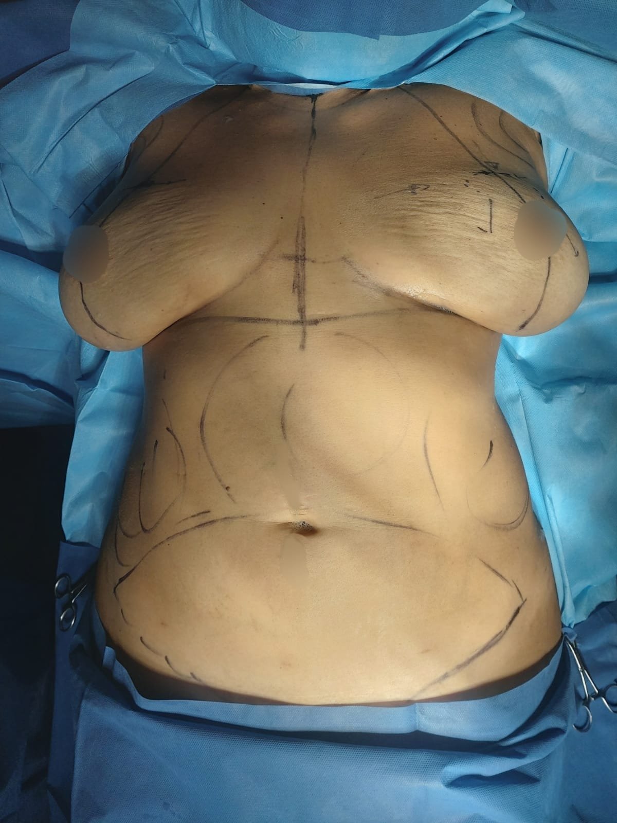 Mommy Makakeover Cancún. Dr Patricia Panamá. Cirujano Plastico en Cancún. Plastic Surgery Cancún (4)