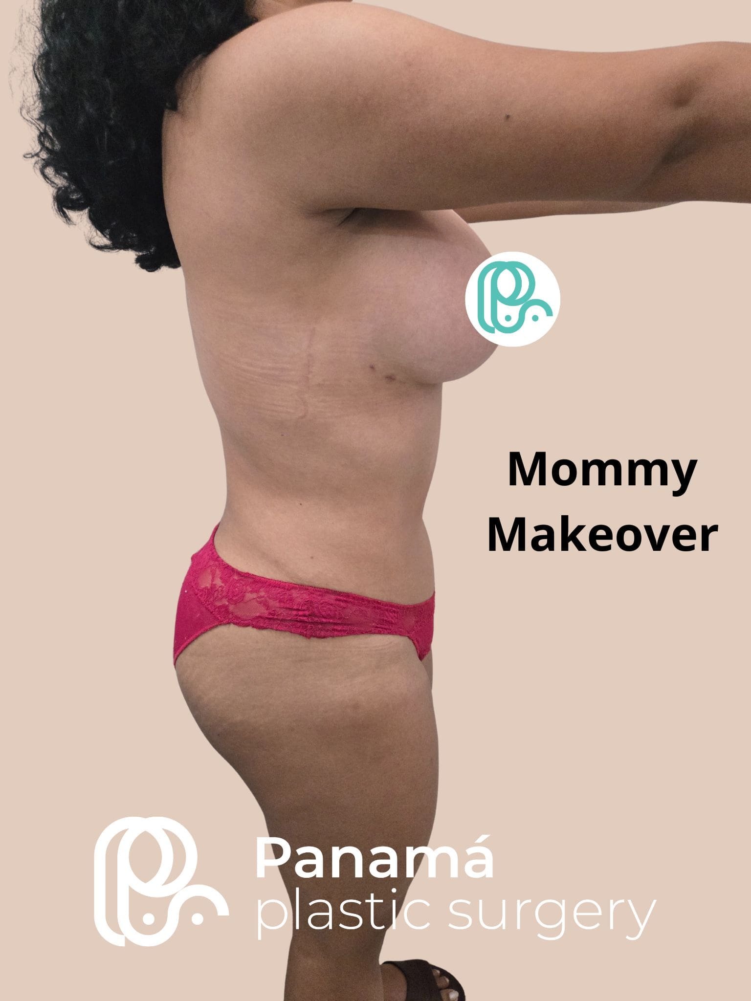 Mommy Makakeover Cancún. Dr Patricia Panamá. Cirujano Plastico en Cancún. Plastic Surgery Cancún (4)