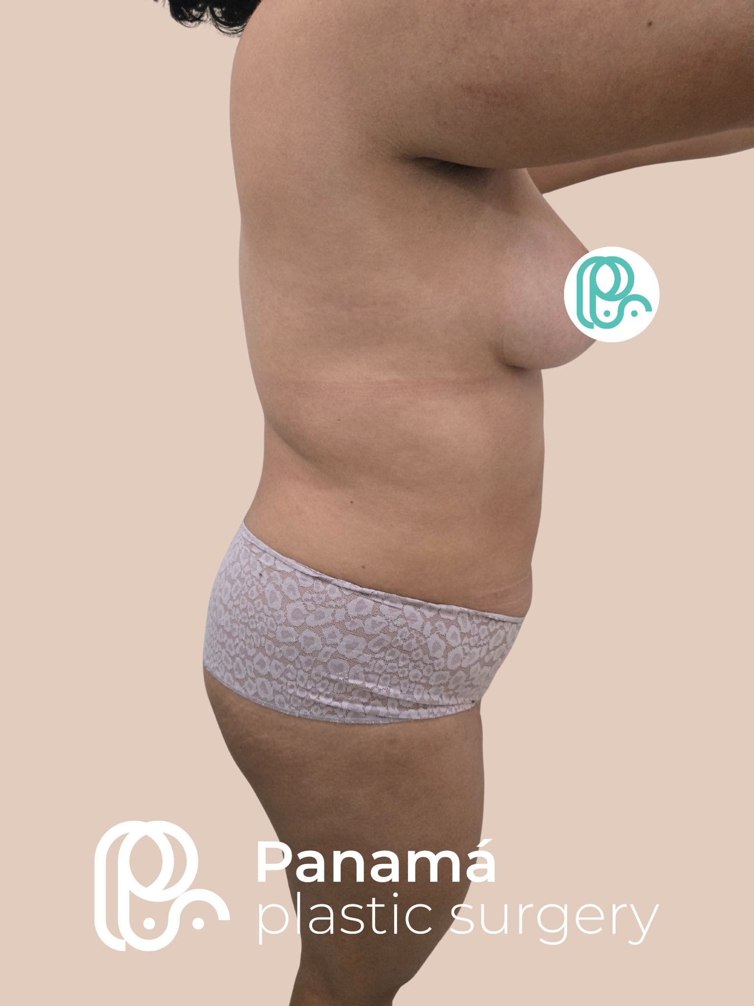 Mommy Makakeover Cancún. Dr Patricia Panamá. Cirujano Plastico en Cancún. Plastic Surgery Cancún (6)