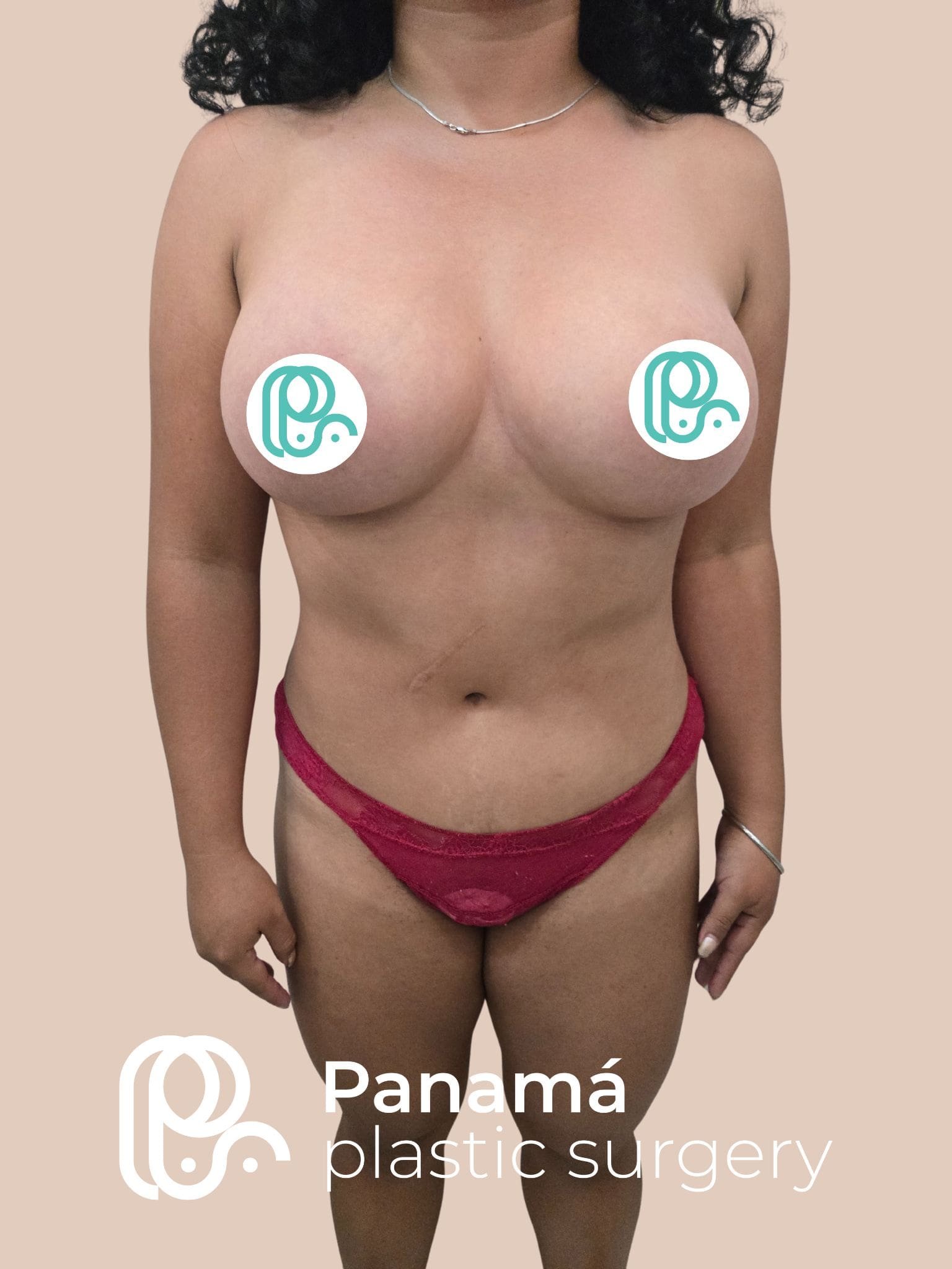 Mommy Makakeover Cancún. Dr Patricia Panamá. Cirujano Plastico en Cancún. Plastic Surgery Cancún (7)