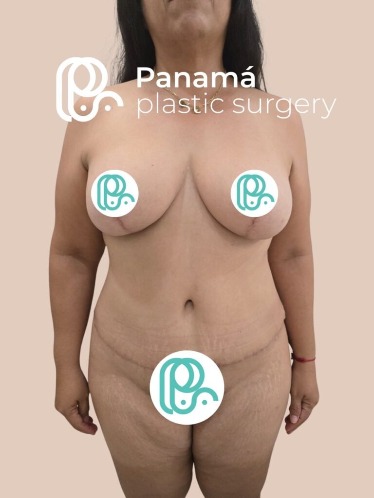 Mommy Makeover Cancún. Dr Patricia Panamá. Cirujano Plástico Cancún (1)