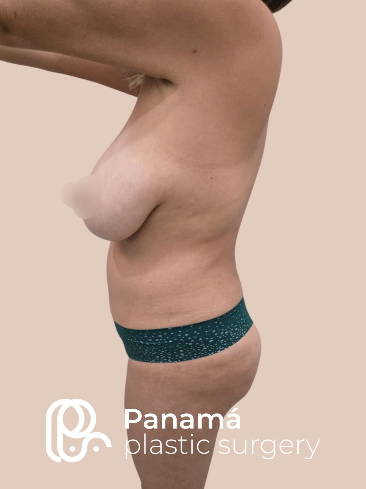 Mommy Makeover Cancún. Dr Patricia Panamá. Cirujano Plástico Cancún (10)