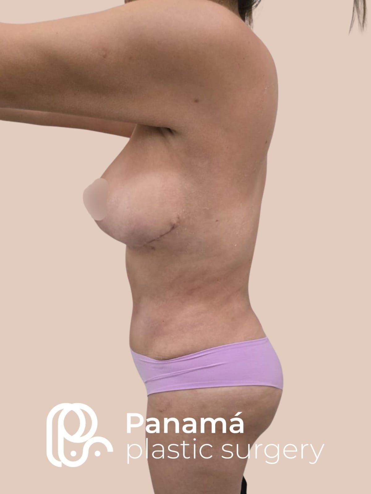 Mommy Makeover Cancún. Dr Patricia Panamá. Cirujano Plástico Cancún (11)