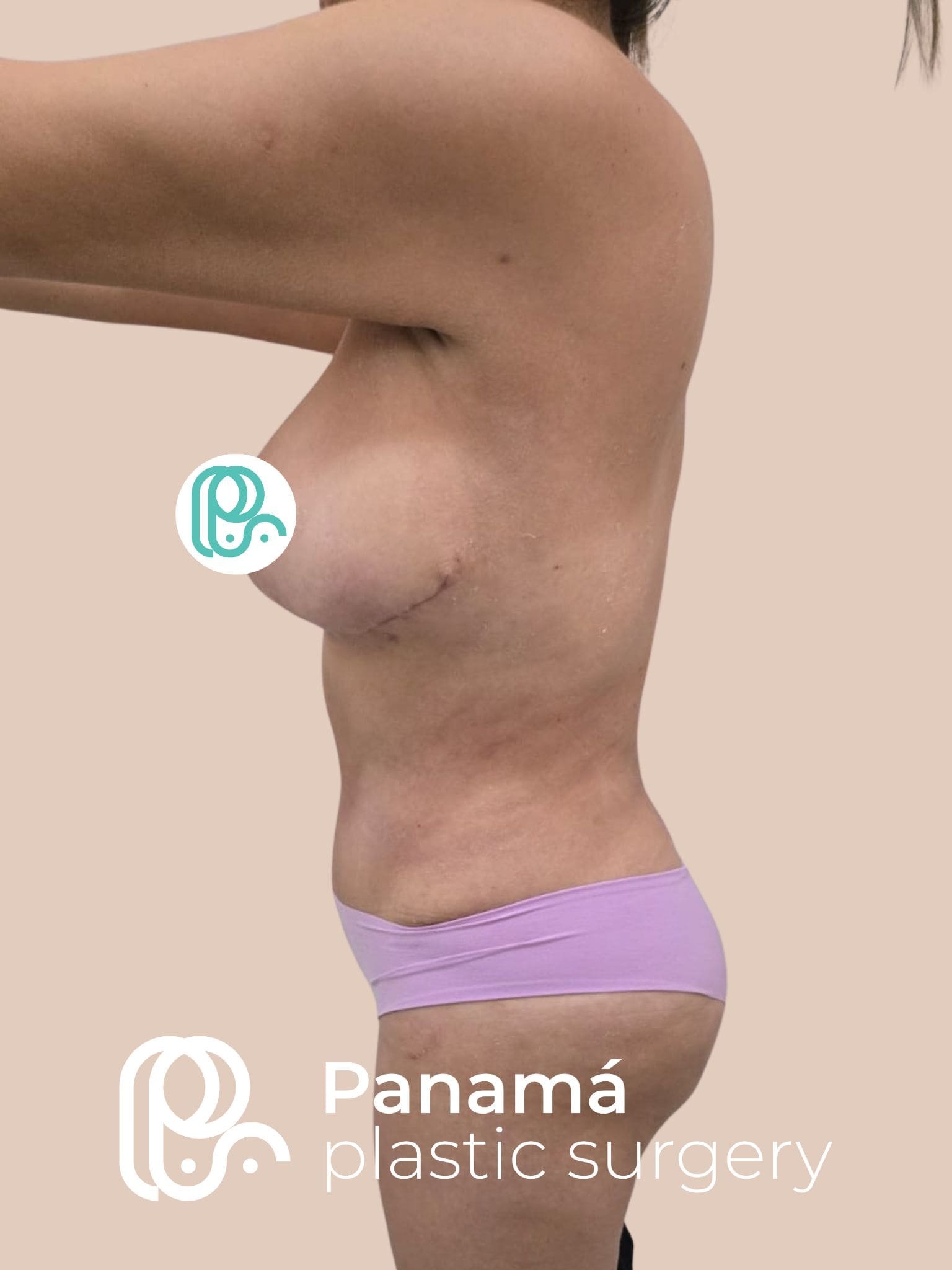 Mommy Makeover Cancún. Dr Patricia Panamá. Cirujano Plástico Cancún (3)