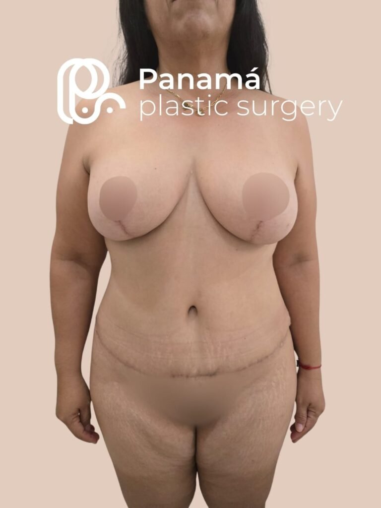 Mommy Makeover Cancún. Dr Patricia Panamá. Cirujano Plástico Cancún (7)