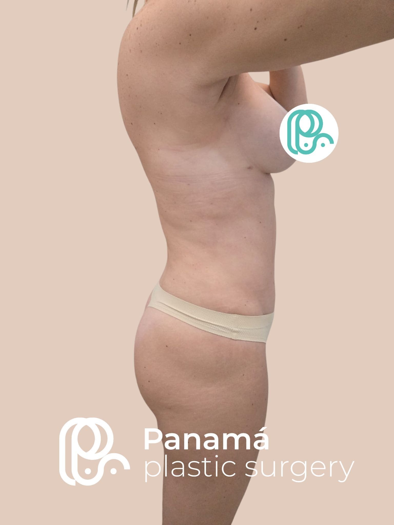 Mommy Makeover Cancún. Dr Patricia Panamá. Cirujano Plástico Cancún (7)