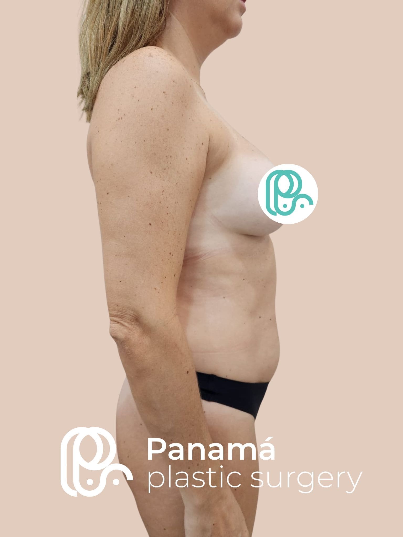 Mommy Makeover Cancún. Dr Patricia Panamá. Cirujano Plástico Cancún (8)
