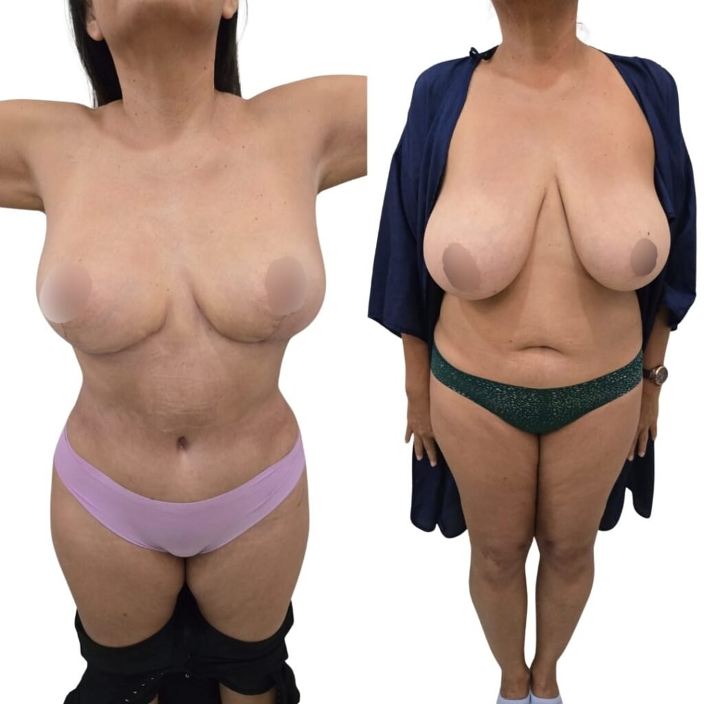 Mommy Makeover Cancún. Dr Patricia Panamá. Cirujano Plástico Cancún (9)
