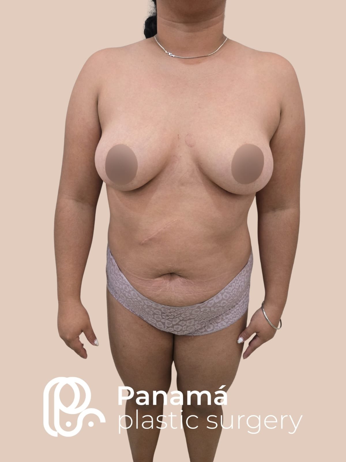 Mommy Makeover Cancún. Dr Patricia Panamá. Cirujano Plastico en Cancún. Plastic Surgery Cancún (2)
