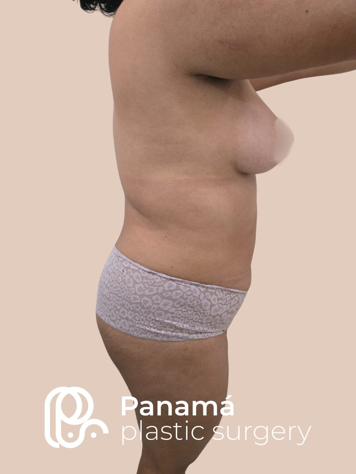 Mommy Makeover Cancún. Dr Patricia Panamá. Cirujano Plastico en Cancún. Plastic Surgery Cancún (3)
