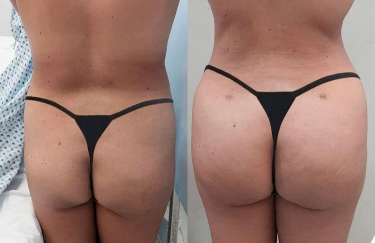 Mommy Makeover in Cancun Mexico. Plastic Surgery in Mexico. Dr Patricia Panama (1)