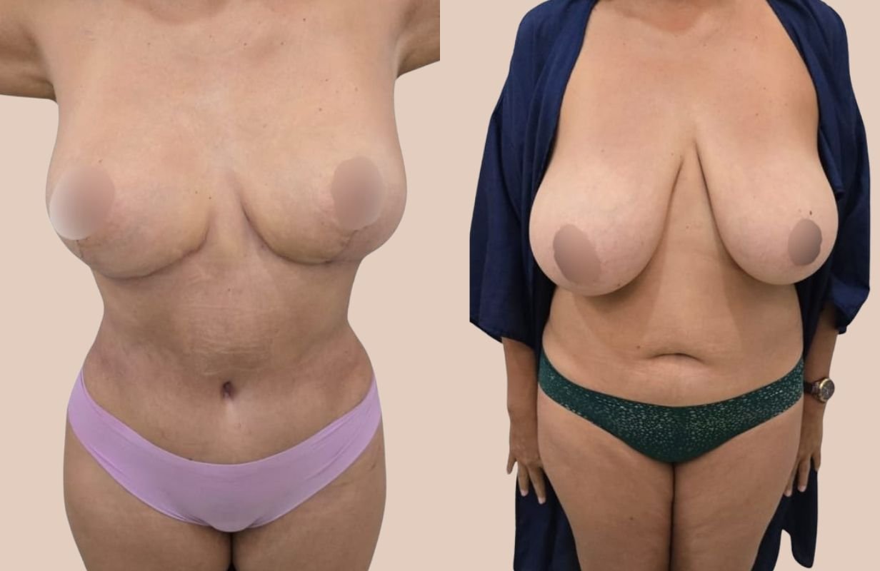 Mommy Makeover in Cancun Mexico. Plastic Surgery in Mexico. Dr Patricia Panama (10)