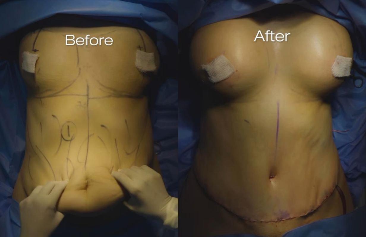 Mommy Makeover in Cancun Mexico. Plastic Surgery in Mexico. Dr Patricia Panama (11)