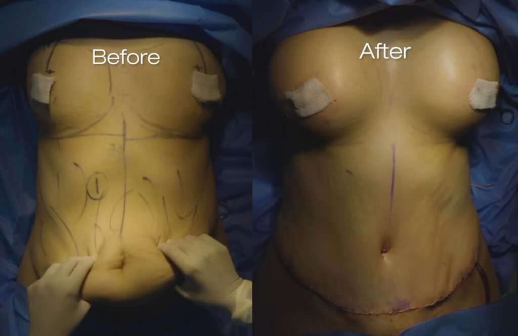 Mommy Makeover in Cancun Mexico. Plastic Surgery in Mexico. Dr Patricia Panama (11)