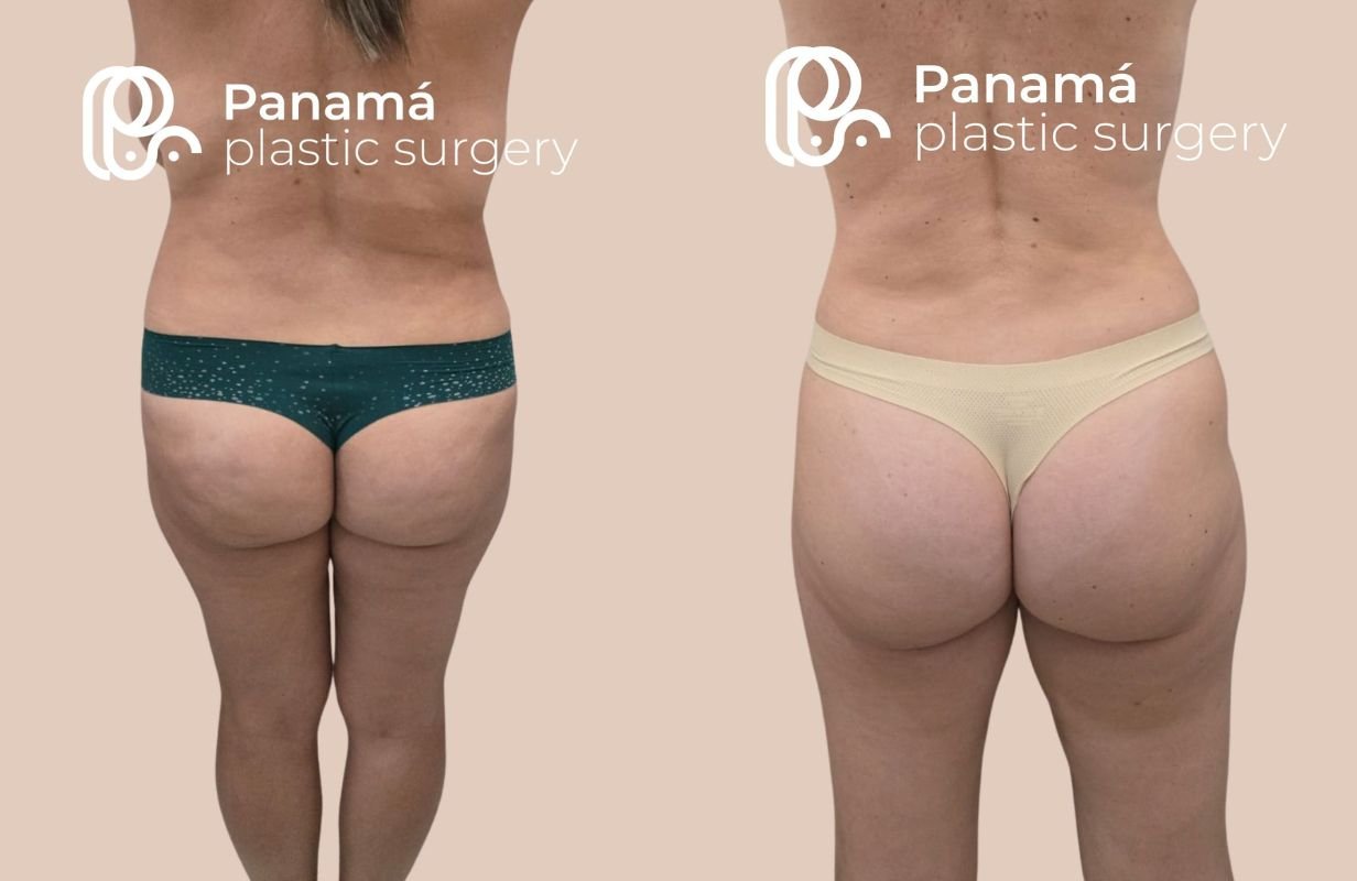 Mommy Makeover in Cancun Mexico. Plastic Surgery in Mexico. Dr Patricia Panama (12)