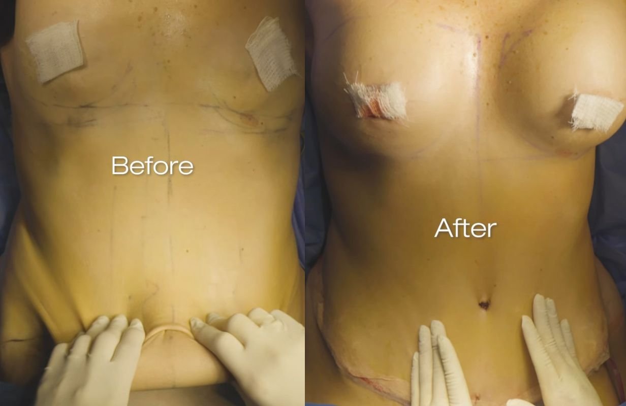 Mommy Makeover in Cancun Mexico. Plastic Surgery in Mexico. Dr Patricia Panama (13)