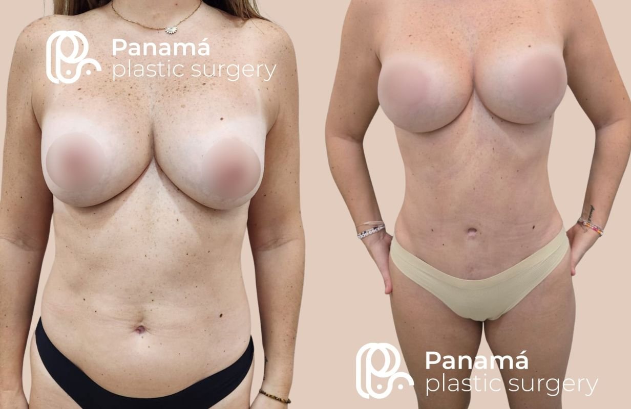 Mommy Makeover in Cancun Mexico. Plastic Surgery in Mexico. Dr Patricia Panama (14)