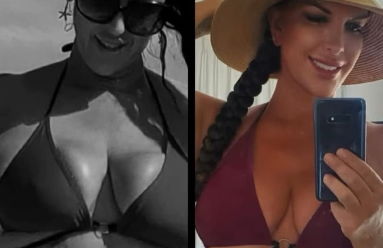 Mommy Makeover in Cancun Mexico. Plastic Surgery in Mexico. Dr Patricia Panama (15)