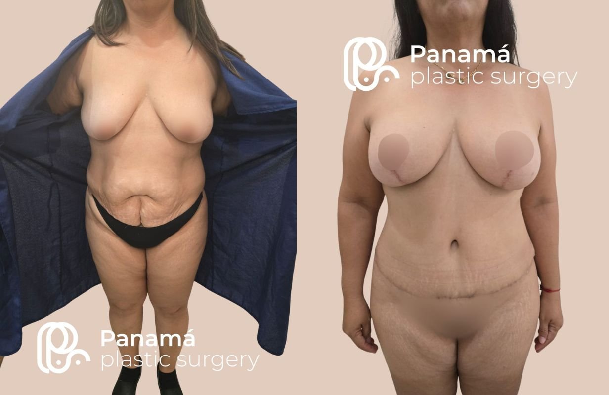 Mommy Makeover in Cancun Mexico. Plastic Surgery in Mexico. Dr Patricia Panama (16)