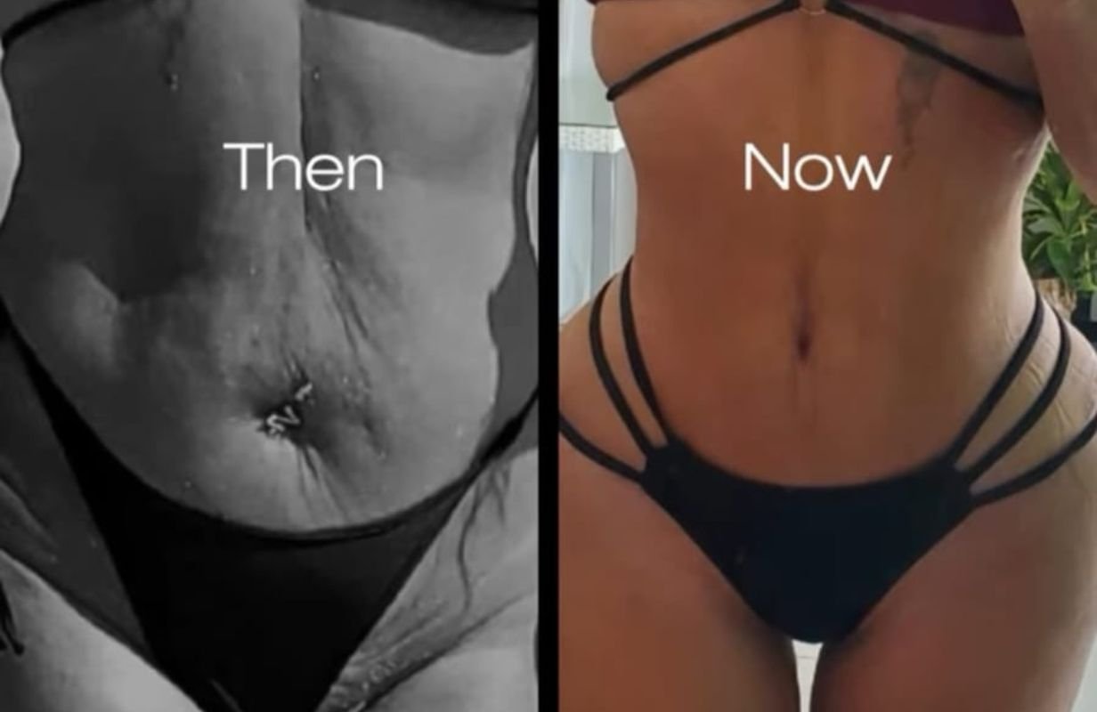 Mommy Makeover in Cancun Mexico. Plastic Surgery in Mexico. Dr Patricia Panama (17)