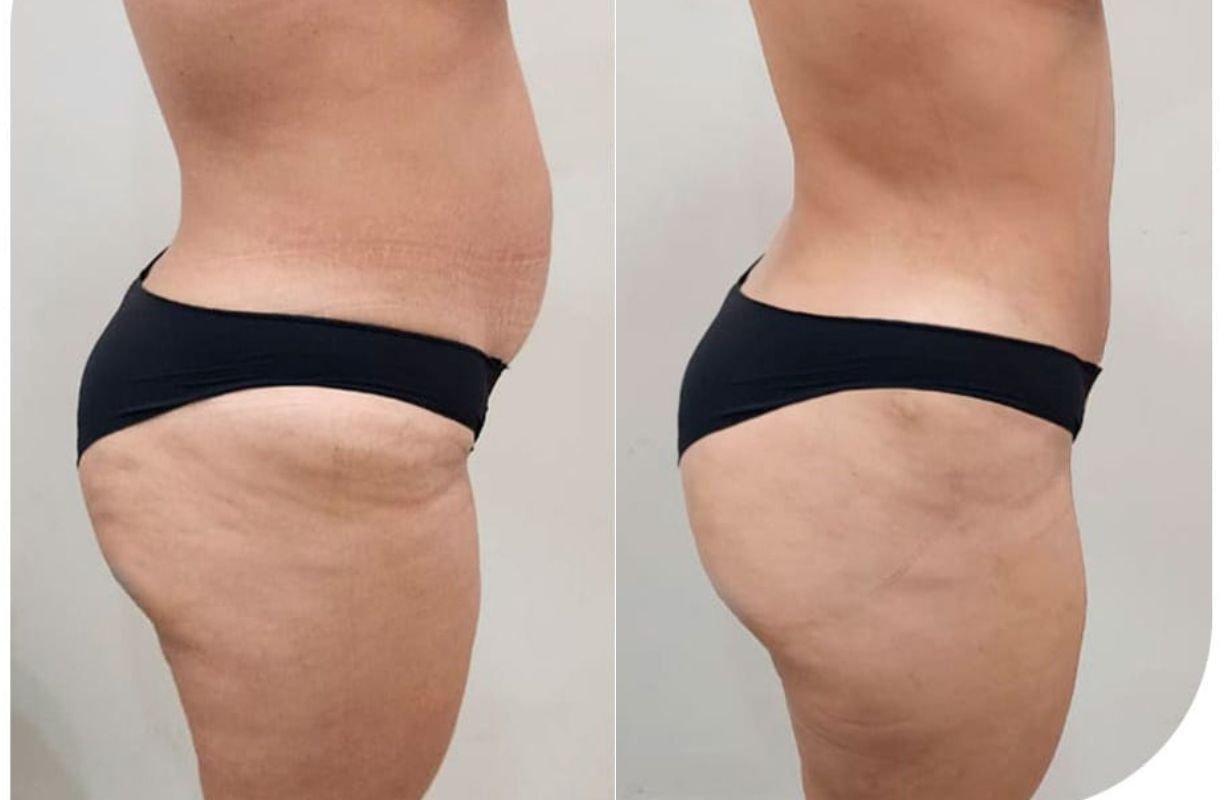 Mommy Makeover in Cancun Mexico. Plastic Surgery in Mexico. Dr Patricia Panama (2)