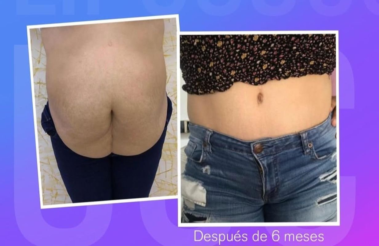 Mommy Makeover in Cancun Mexico. Plastic Surgery in Mexico. Dr Patricia Panama (3)