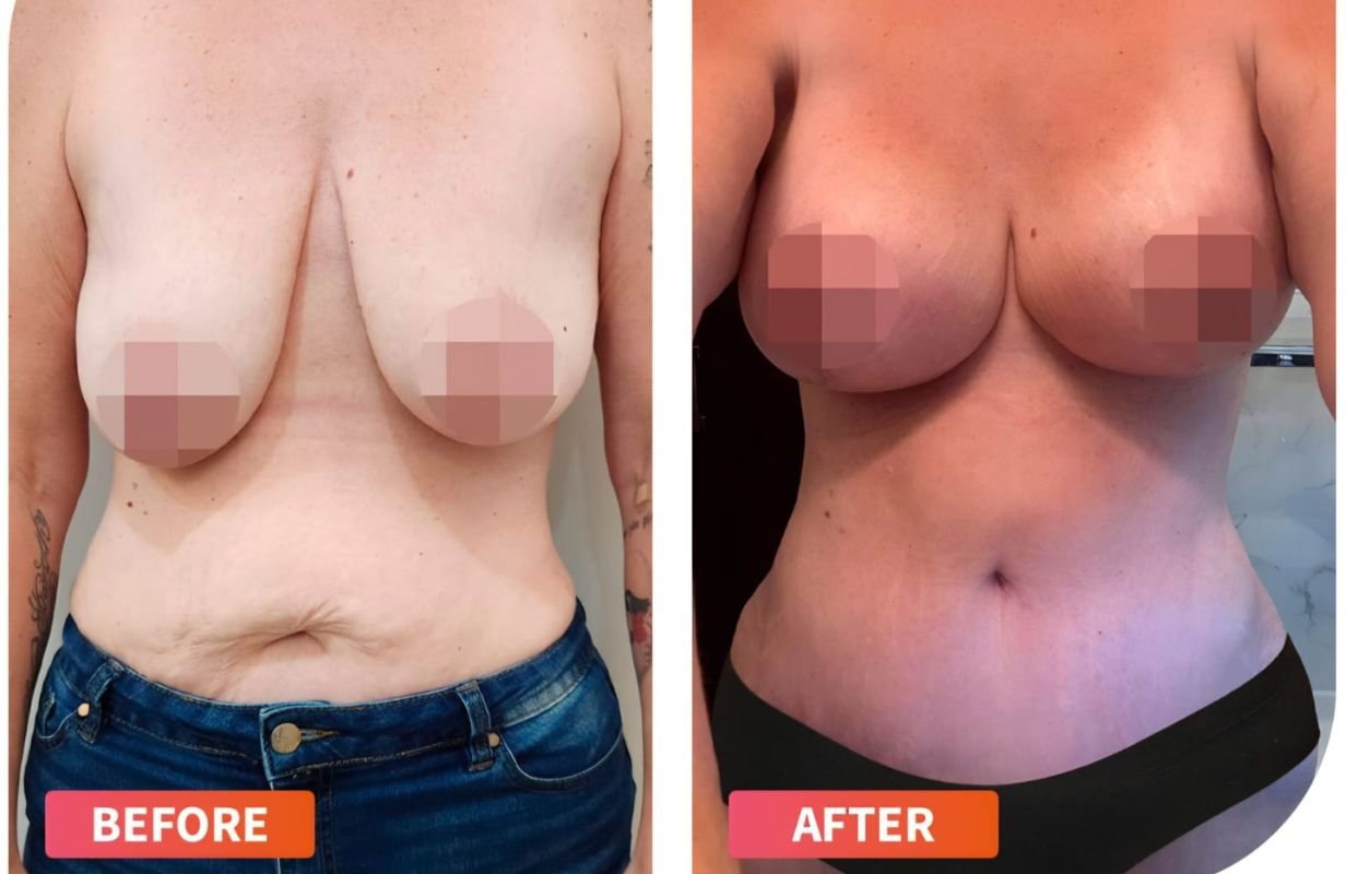 Mommy Makeover in Cancun Mexico. Plastic Surgery in Mexico. Dr Patricia Panama (4)