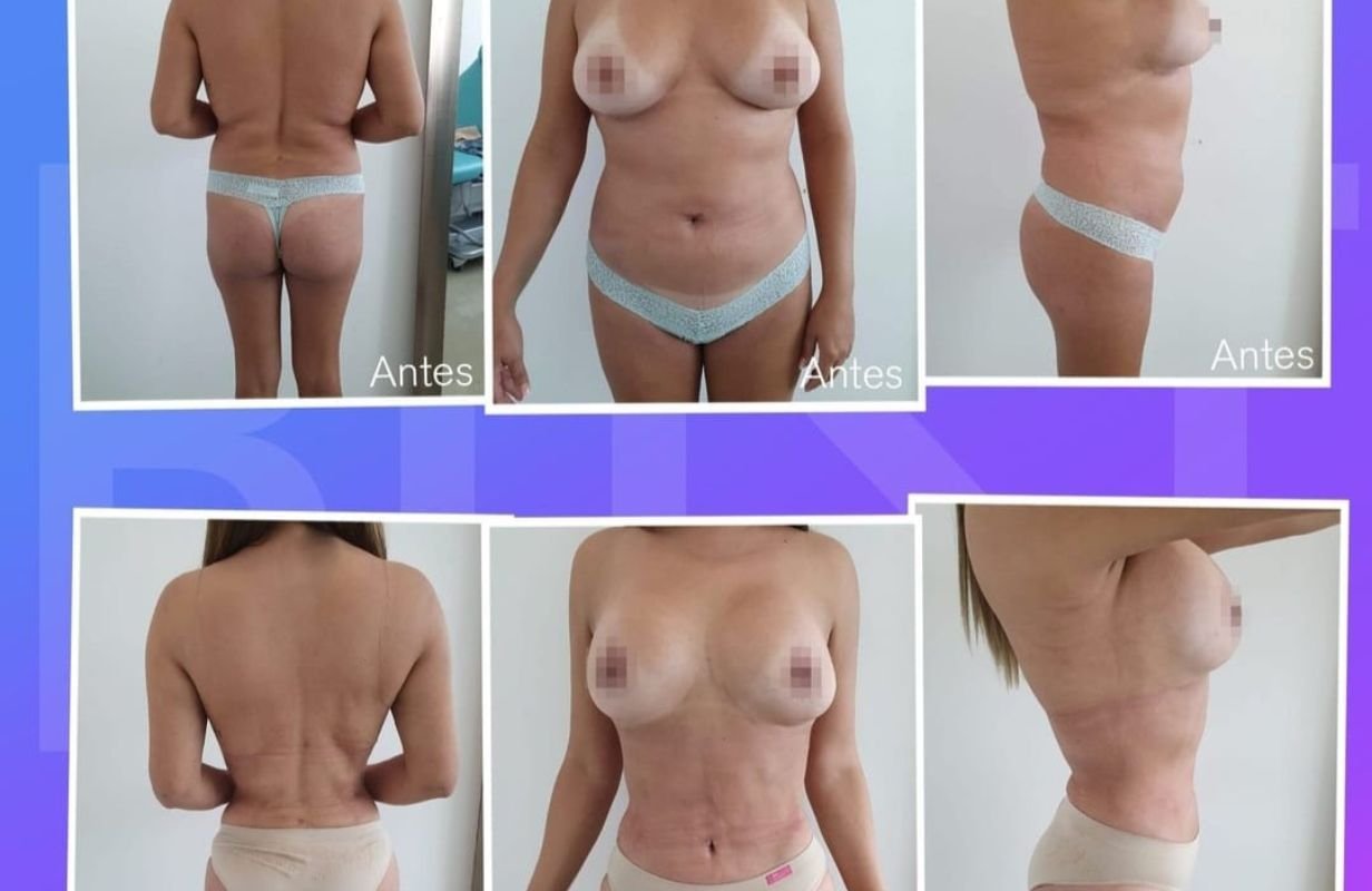 Mommy Makeover in Cancun Mexico. Plastic Surgery in Mexico. Dr Patricia Panama (5)