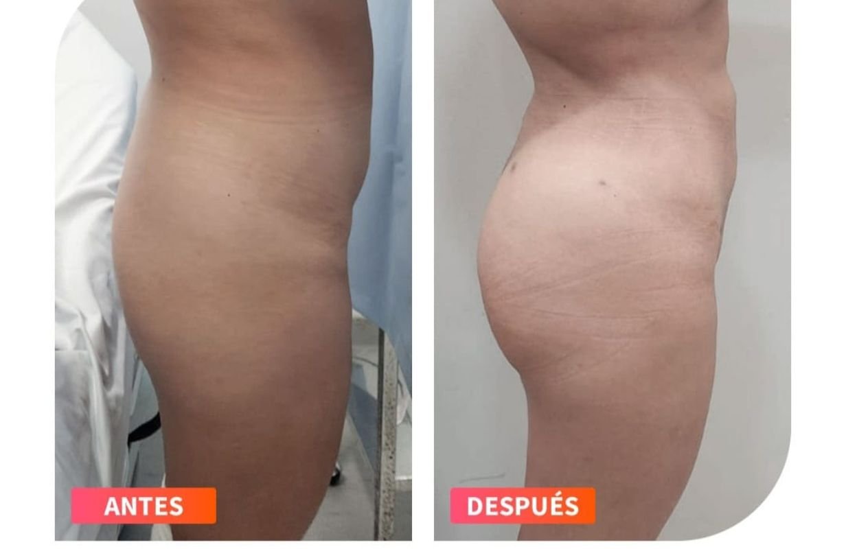Mommy Makeover in Cancun Mexico. Plastic Surgery in Mexico. Dr Patricia Panama (6)