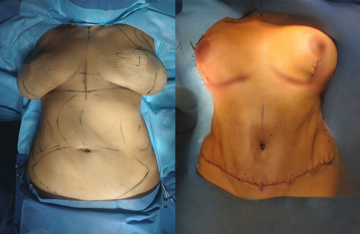Mommy Makeover in Cancun Mexico. Plastic Surgery in Mexico. Dr Patricia Panama (7)