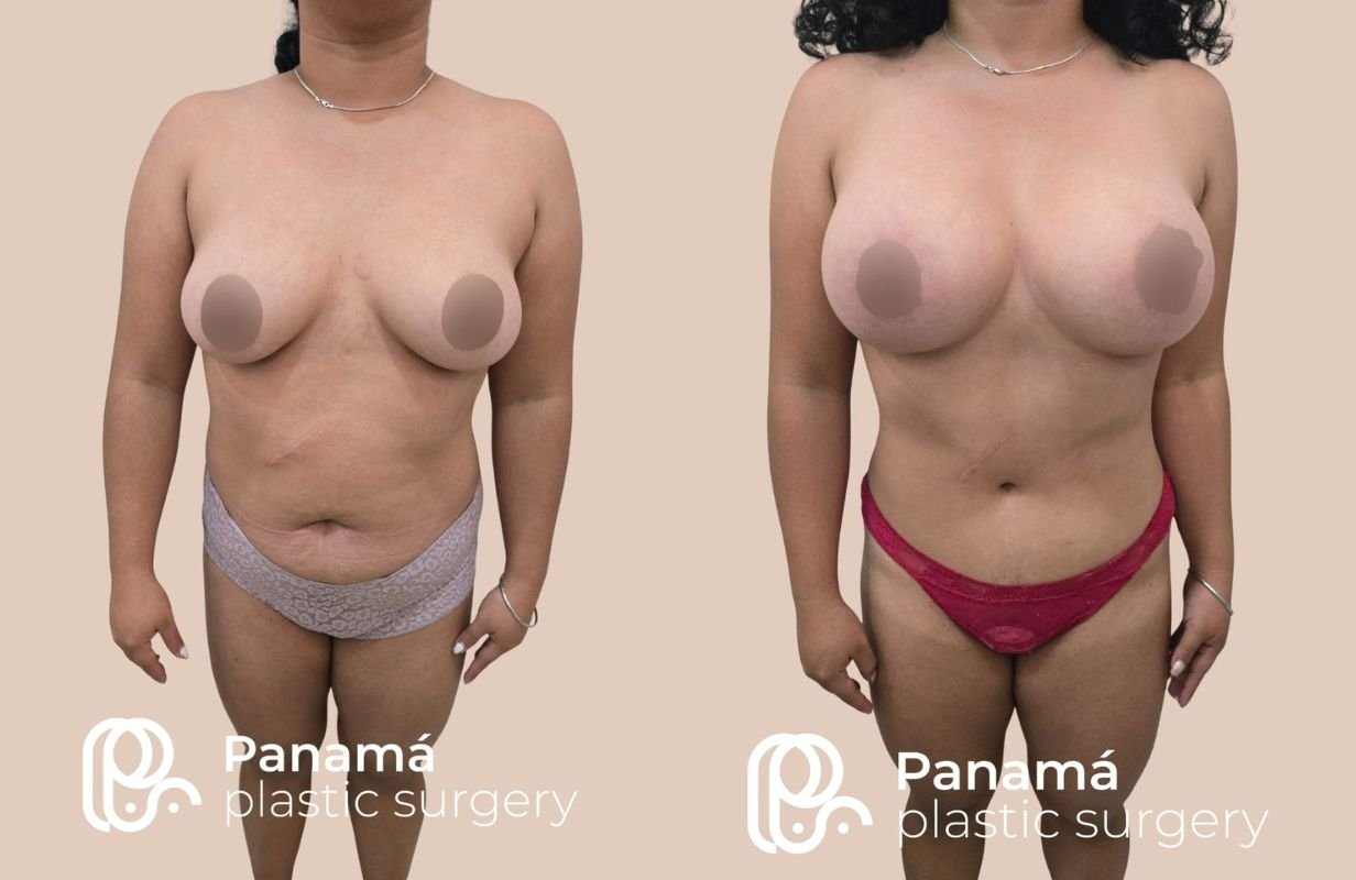 Mommy Makeover in Cancun Mexico. Plastic Surgery in Mexico. Dr Patricia Panama (8)