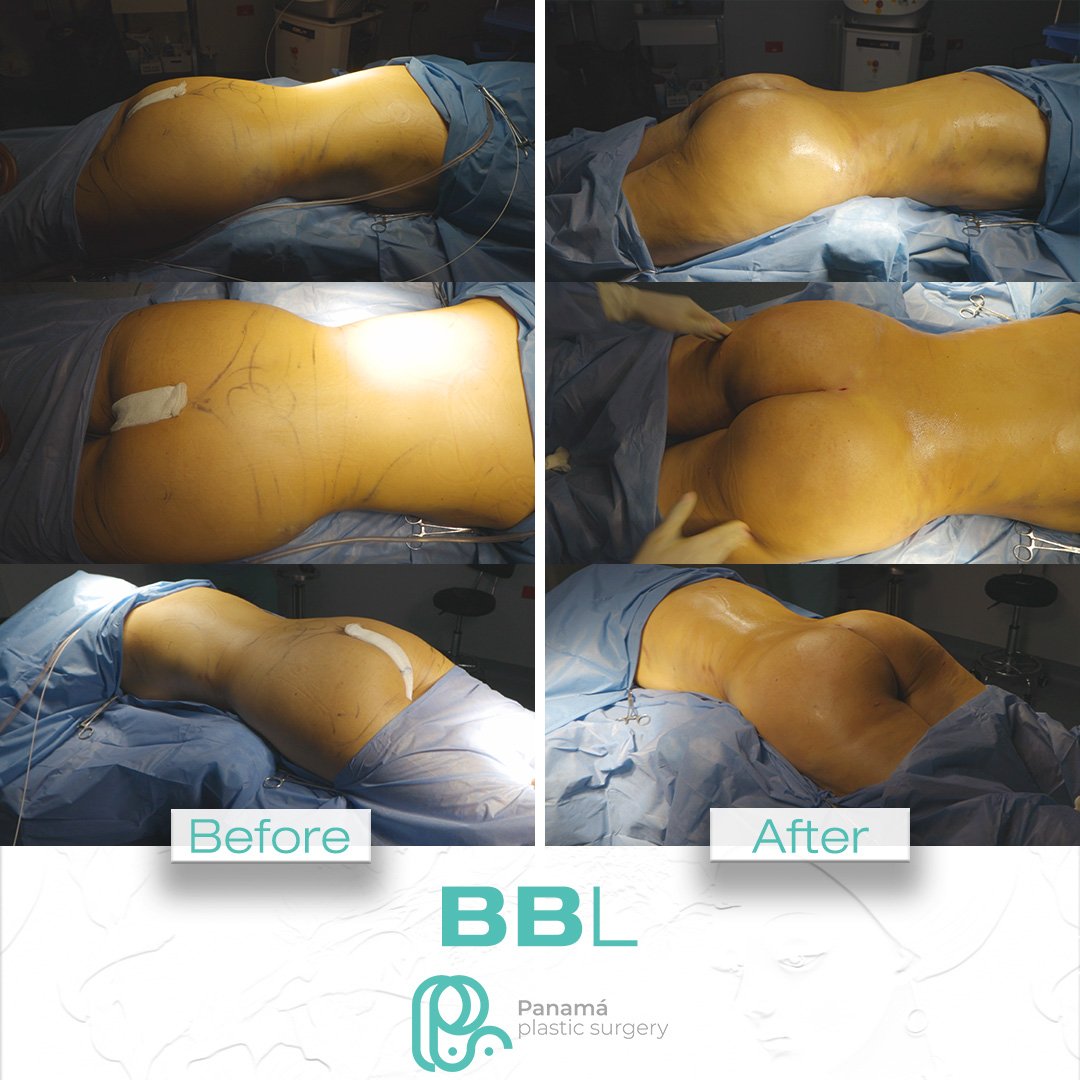 BBL_1