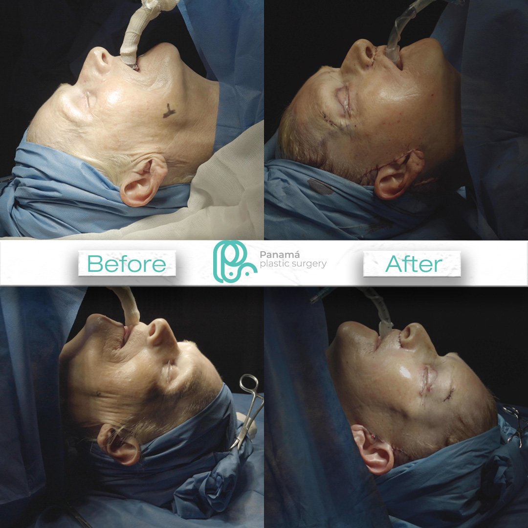 Facelift in Cancun Mexico. Dr. Patricia Panamá. Plastic Surgeon in Mexico (1)