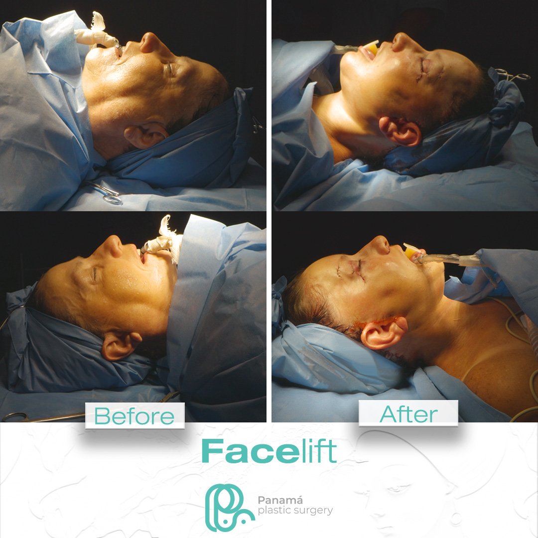 Facelift in Cancun Mexico. Dr. Patricia Panamá. Plastic Surgeon in Mexico (10)
