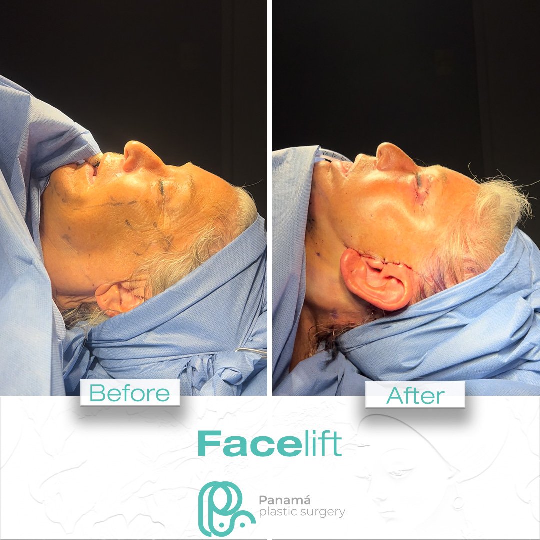 Facelift in Cancun Mexico. Dr. Patricia Panamá. Plastic Surgeon in Mexico (11)
