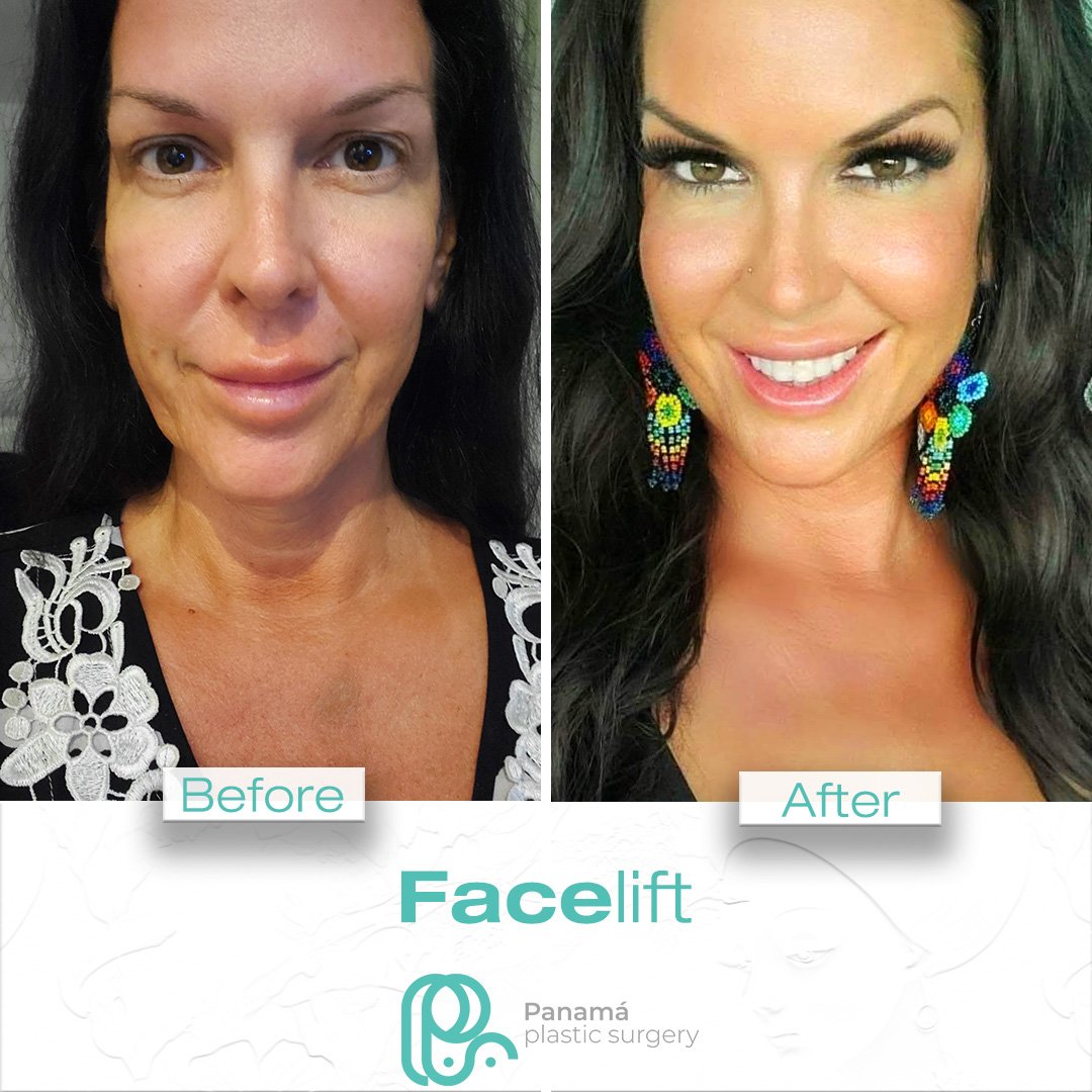 Facelift in Cancun Mexico. Dr. Patricia Panamá. Plastic Surgeon in Mexico (12)