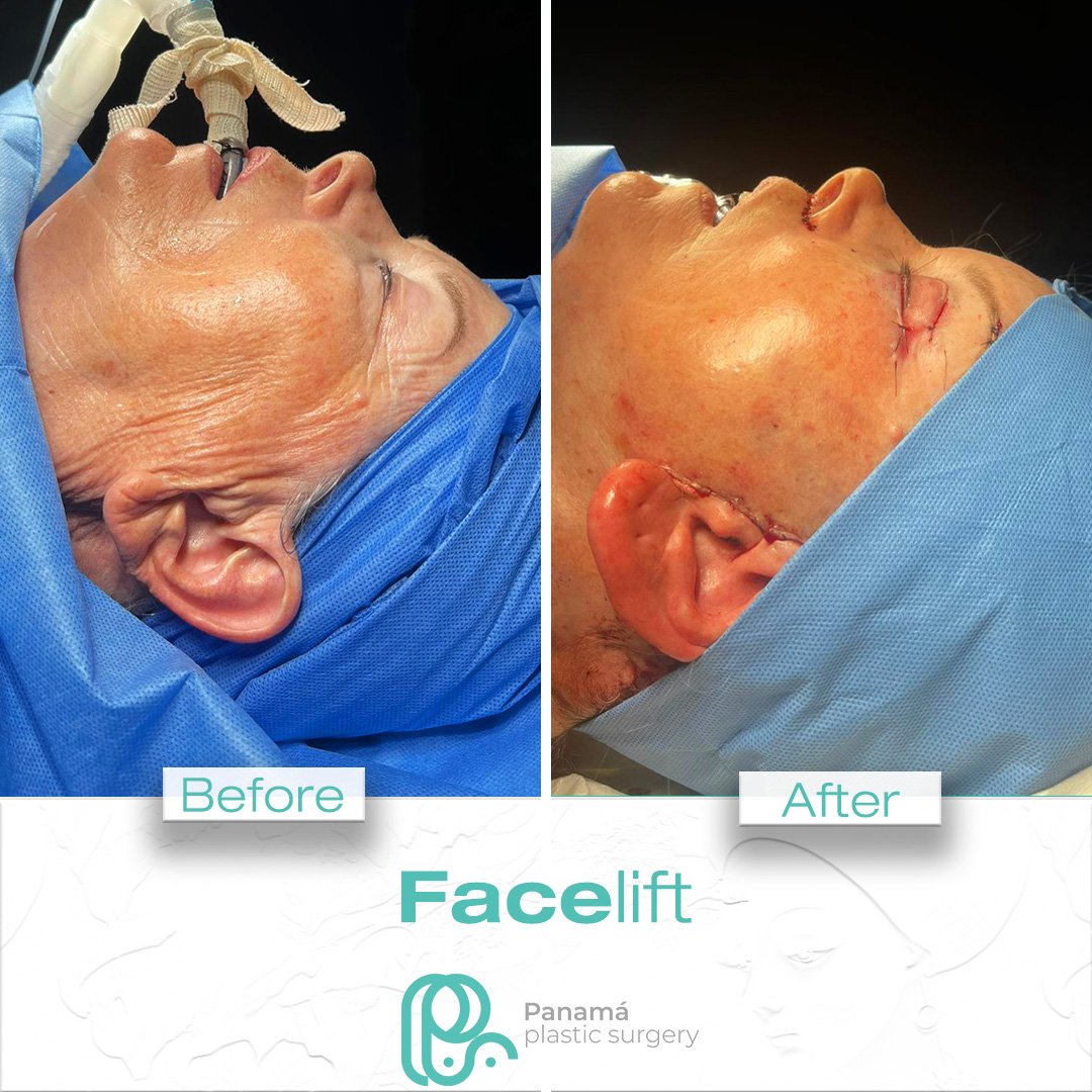 Facelift in Cancun Mexico. Dr. Patricia Panamá. Plastic Surgeon in Mexico (13)