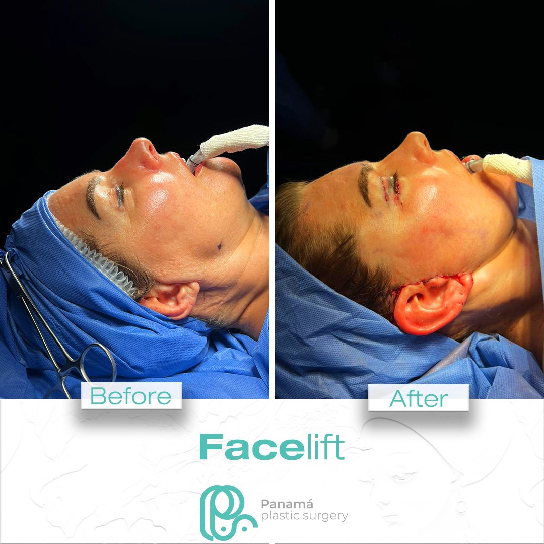 Facelift in Cancun Mexico. Dr. Patricia Panamá. Plastic Surgeon in Mexico (14)