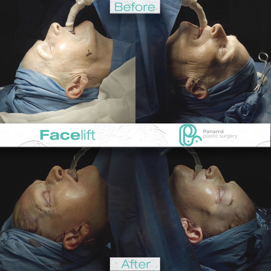 Facelift in Cancun Mexico. Dr. Patricia Panamá. Plastic Surgeon in Mexico (2)